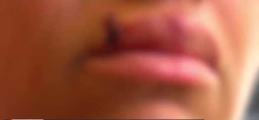 Mulher é agredida e perde dente após reagir a assalto Mulher é agredida e perde dente após reagir a assalto