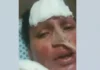 Jovem de 27 anos sai do coma após um mês e acusa marido de tentar matá-la queimada
