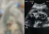 Jovem de 20 anos morre ao tentar realizar aborto clandestino dentro de motel