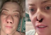 Mulher faz tratamento dentário e fica com ‘buraco’ no rosto: ‘Estou com medo’