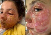 Menina sofre queimaduras no rosto após reproduzir desafio viral de rede social