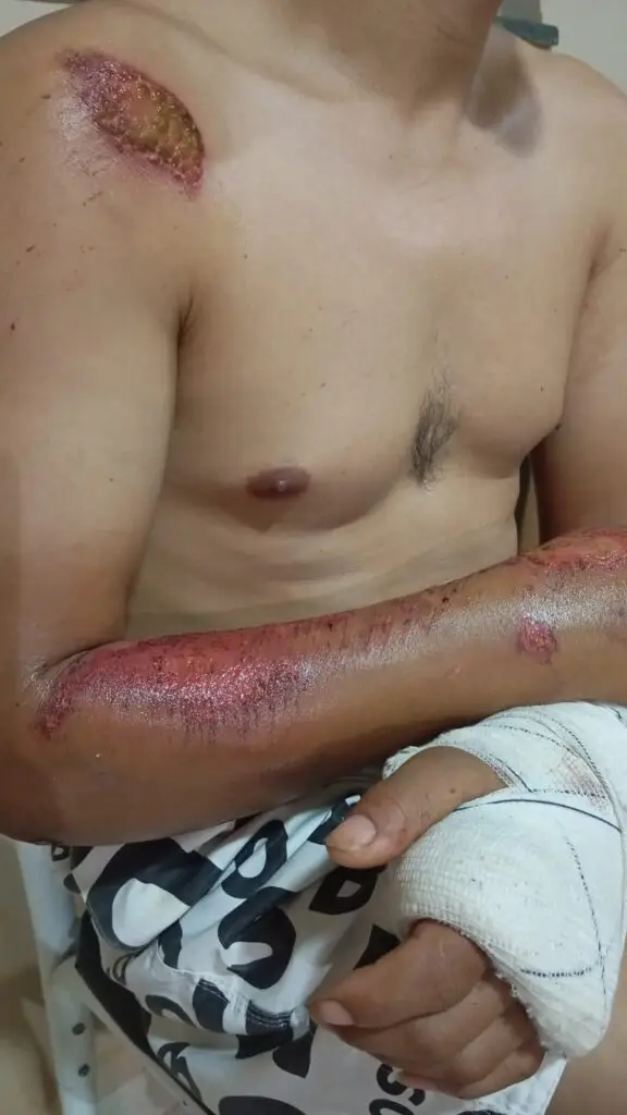 Esposa denuncia negligência após acidente com quebra-mola não sinalizado em Dourados Esposa denuncia negligência após acidente com quebra-mola não sinalizado em Dourados