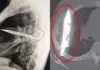 Homem vai ao médico com secreção no peito e descobre faca alojada há 8 anos