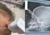 Criança de 1 ano fica com carregador cravado na testa ao cair da cama