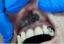 Cena de terror: Idosa é resgatada com larvas na boca e morre após dias internada